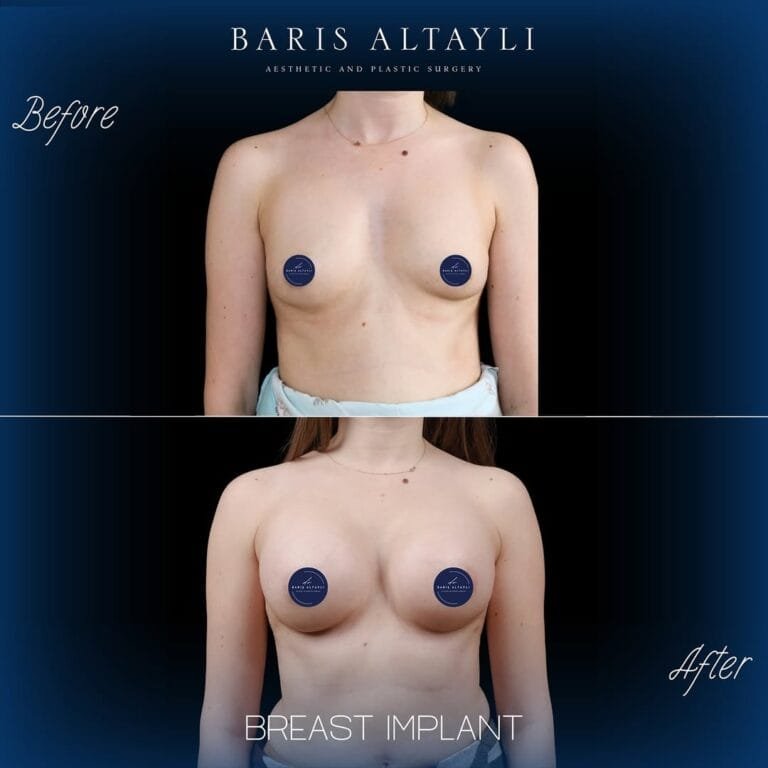 Breast Augmentation Before and After