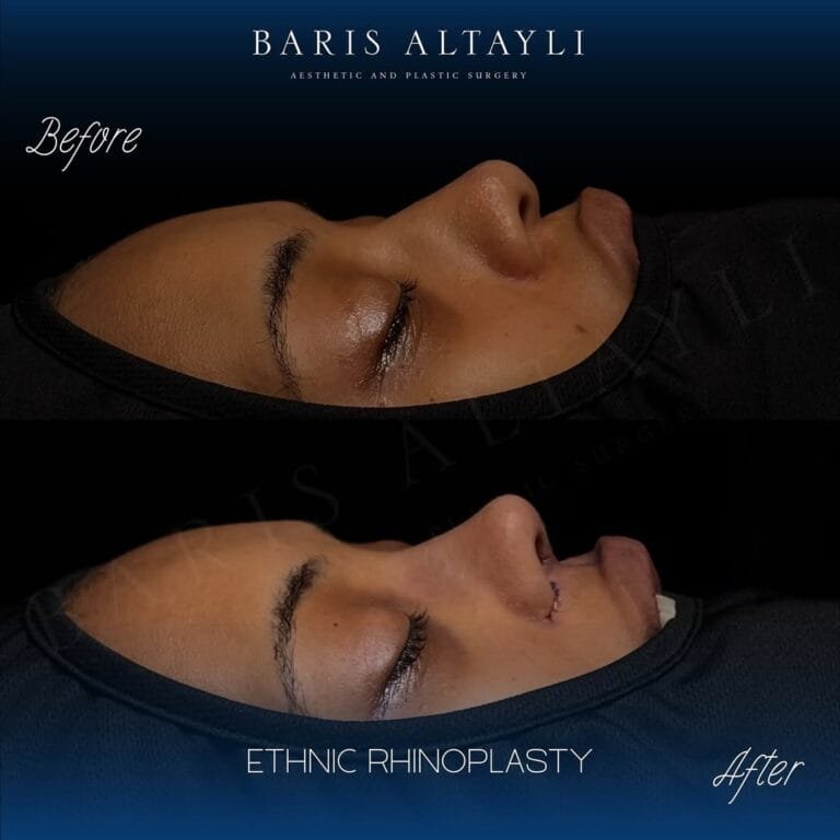 What Is the Ideal Age for Rhinoplasty?