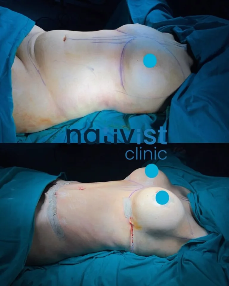 Is Tummy Tuck Surgery Risky?