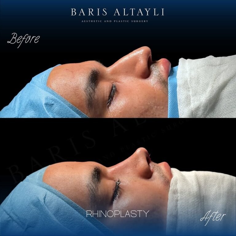 Male Rhinoplasty
